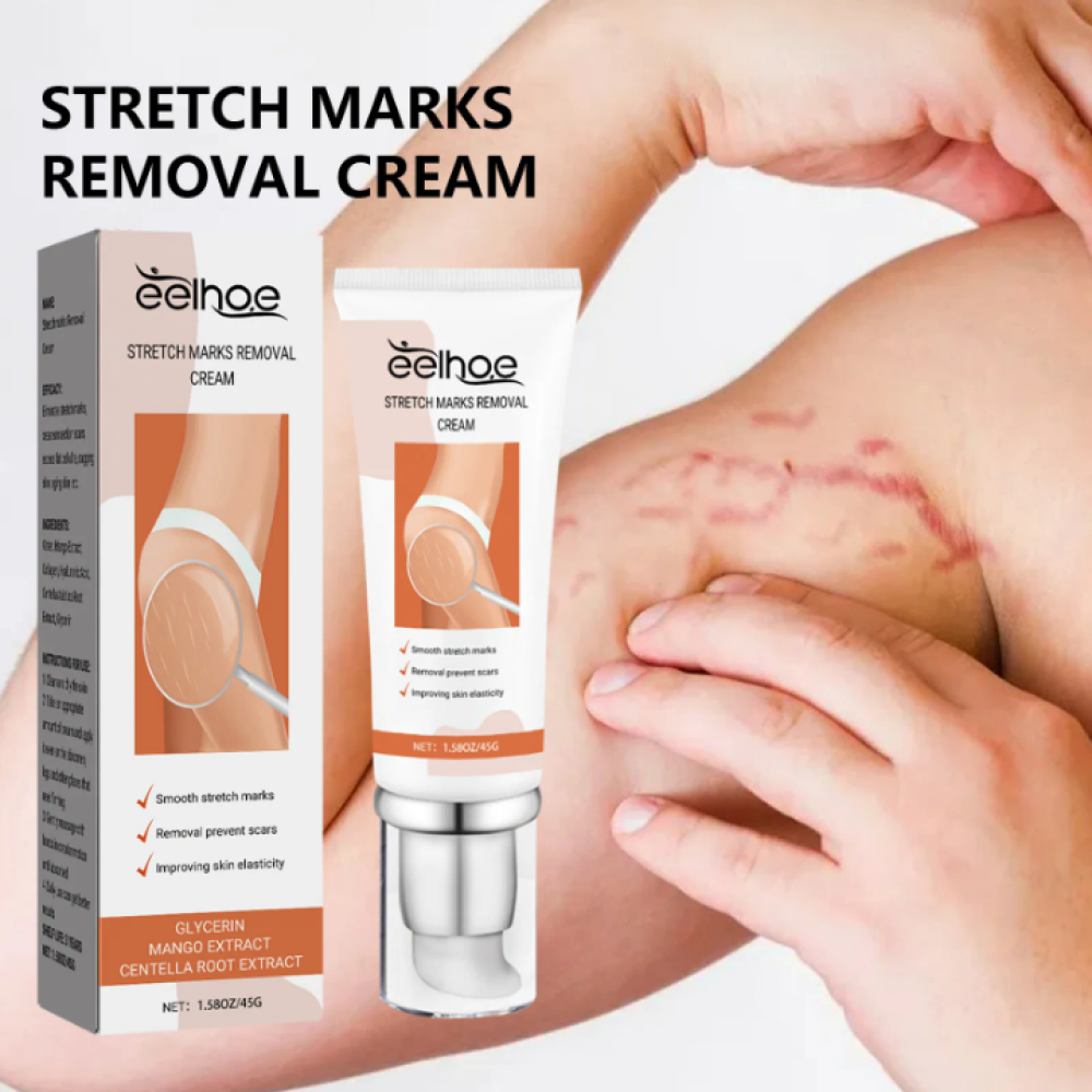 Stretch marks removal cream
